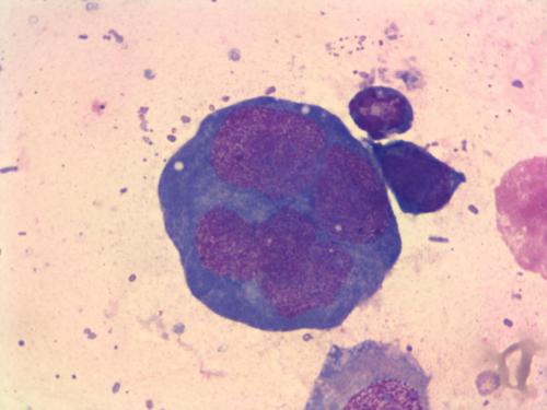 小淋巴细胞淋巴瘤